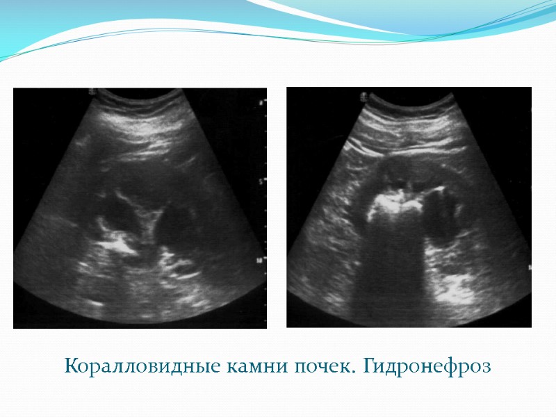 Коралловидные камни почек. Гидронефроз